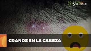 ✅ Cómo lidiar con los GRANOS en la CABEZA  Salud180 🌿 [upl. by Danella]