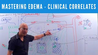 Mastering Edema  Types Causes Symptoms amp Treatment 👨‍⚕️ [upl. by Alick333]