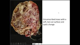 Renal Tumors Case 6 [upl. by Ileyan483]