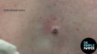 8 MINUTES OF SATISFYING POPS with Dr Sandra Lee  Dr Pimple Popper [upl. by Alanah]