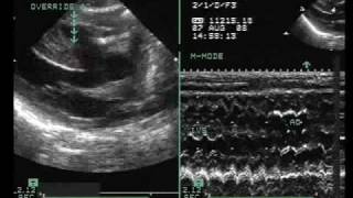 Tetralogy of Fallot with Vertically Oriented PDA [upl. by Pirzada]