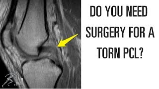 Do you need surgery for a torn PCL [upl. by Ahsata]