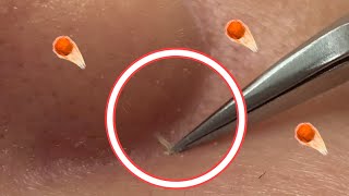 กดสิว blackheads filaments on nose remove with tweezers [upl. by Skill222]