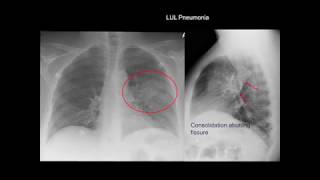 Chest Xray Cases 1 [upl. by Colas742]