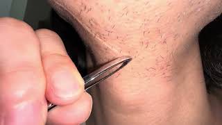 ASMR，4K ，Macro Photography 拔络腮胡，太解压了 Pulling out beard This beard looks like blackheads [upl. by Meelak500]