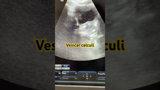 Vesical Calculi Cystoliths videos reels urinarybladder stones calculus cystitis ultrasound [upl. by Lorie]