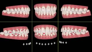 INVISALIGN Design the perfect clincheck and sequence of movements [upl. by Ennoira]