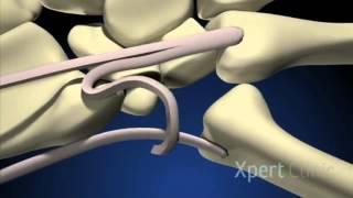 Rizartrosis tenosuspensiónTendon interposition arthroplasty [upl. by Treiber]