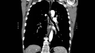 Acute massive pulmonary embolism with right heart strain CT Coronal JETem 2017 [upl. by Sorgalim]