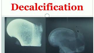 2 Decalcification MLTLectures [upl. by Lanos579]