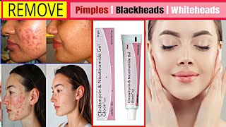 Skin Whitening Cream  Remove Acne Pimples Dark spots Clear amp Bright Skin 💯 Results [upl. by Gebhardt]