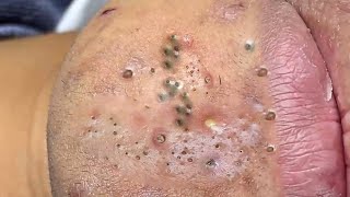 Big Cystic Acne Blackheads Extraction Blackheads amp Milia Whiteheads Removal Pimple Popping  2471 [upl. by Bronder820]