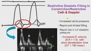 Constrictive Pericarditis [upl. by Yremrej]