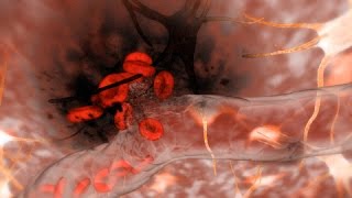 Hemorrhagic Stroke Brain Hemorrhage [upl. by Jerman]