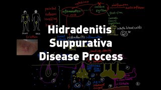 Hidradenitis Suppurativa HS or Acne Inversa Disease Process Explained [upl. by Howenstein]