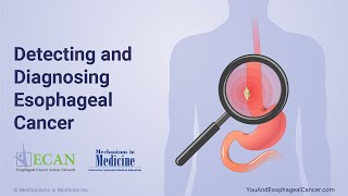 Detecting and Diagnosing Esophageal Cancer [upl. by Atsylak]