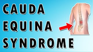 Cauda Equina Syndrome [upl. by Phoebe439]