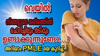 IADVL Kerala Charmarogyam PMLE [upl. by Enilrek]