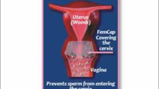 What is the FemCap Cervical Cap [upl. by Alakim417]