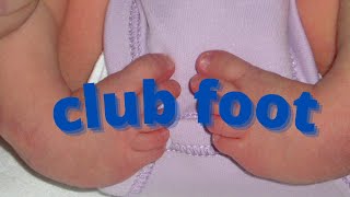 Club foot congenital talipes equinavarus  congenital orthopedic [upl. by Mayce]