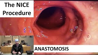 The NICE Procedure PostOP Anastomosis [upl. by Pish212]