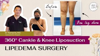 LIPEDEMA  360° CANKLE amp KNEE LIPOSUCTION  Artlipo  Expert Dr Thomas Su [upl. by Boser686]