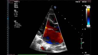 Anterior Mitral Valve Prolapse [upl. by Solotsopa]