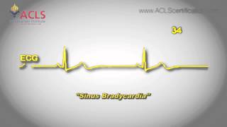 Sinus Bradycardia by ACLS Certification Institute [upl. by Akiehs]