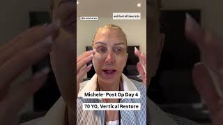 DAY 4 of Facelift Healing amp Recovery How its ACTUALLY Going [upl. by Tonye]