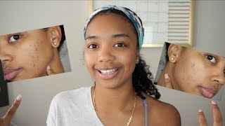 How I Got Rid of my Acne Marks  My Retin A Journey [upl. by Kcirre]