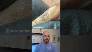 Ingrown hair frenzy ingrownhair dermreacts doctorreacts [upl. by Broucek219]