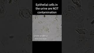 Are epithelial cells in urine contamination [upl. by Areta]