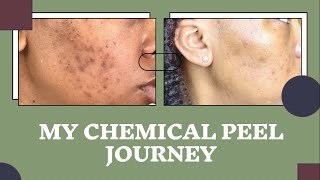 Chemical Peel Journey  Hyperpigmentation on Black Skin  TCA Peel [upl. by Netsryk]