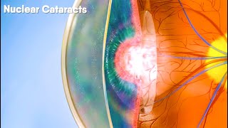 Do you know there are different types of cataracts Dandelion Medical Animation [upl. by Sherj]