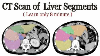 CT scan of Liver segments anatomy [upl. by Nonnac792]