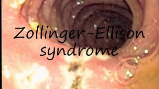 How to Pronounce ZollingerEllison syndrome [upl. by Dominica]