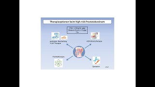 Therapieoptionen beim highriskProstatakarzinom  Strahlentherapie Prof Hilke Vorwerk [upl. by Kcerb626]