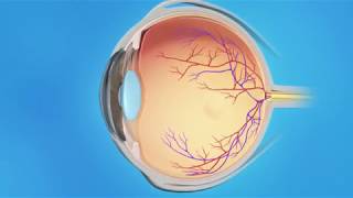 Cystoid Macular Edema Treatment  Medication Injection [upl. by Alitha625]