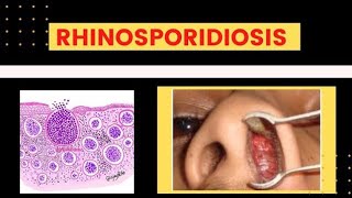 Rhinosporidiosis Subcutaneous Mycosis [upl. by Enileoj]