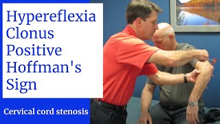 Hyperreflexia Clonus Positive Hoffmans Sign Central Cervical Spine Stenosis [upl. by Oulman828]