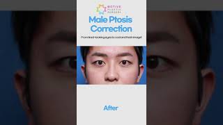 Getting Rid of Unnaturally Thick Double Eyelids  Male Ptosis Correction [upl. by Mirth62]