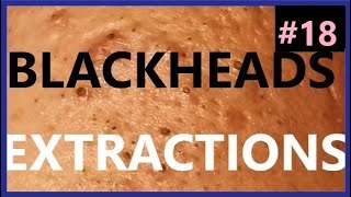 BLACKHEADS EXTRACTIONS on Happy 18 [upl. by Dido110]