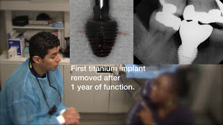 Possible titanium dental implant allergy solved with a CeraRoot zirconia implant [upl. by Enilrae926]