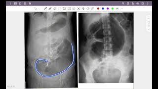 Abdominal radiograph part 3  calcification amp volvulus [upl. by Ocana]