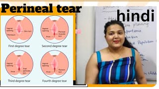 perineal trauma  perineal tear  degrees  management hindi [upl. by Rudman]