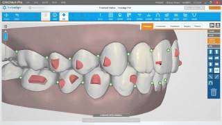 ClinCheck Pro Attachments e Precision Cuts  Sistema Invisalign  Blumenau SC [upl. by Nilam973]