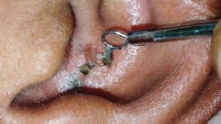 sac be spa blackheads elderly in ear👂 2025  sac be spa old age blackheads 2024  sac be spa ears 2 [upl. by Lesde]