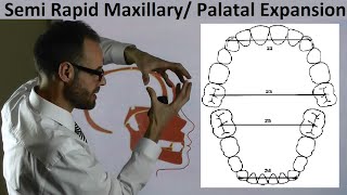 Mechanism of Semi Rapid Palatal Maxillary Expansion amp Teeth Position on Arches by Dr Mike Mew [upl. by Healey311]