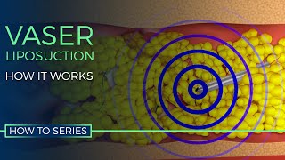 How VASER Liposuction Works  HOW TO SERIES [upl. by Keil]