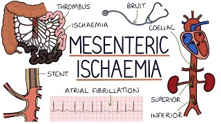 Understanding Mesenteric Ischaemia [upl. by Naahsar]